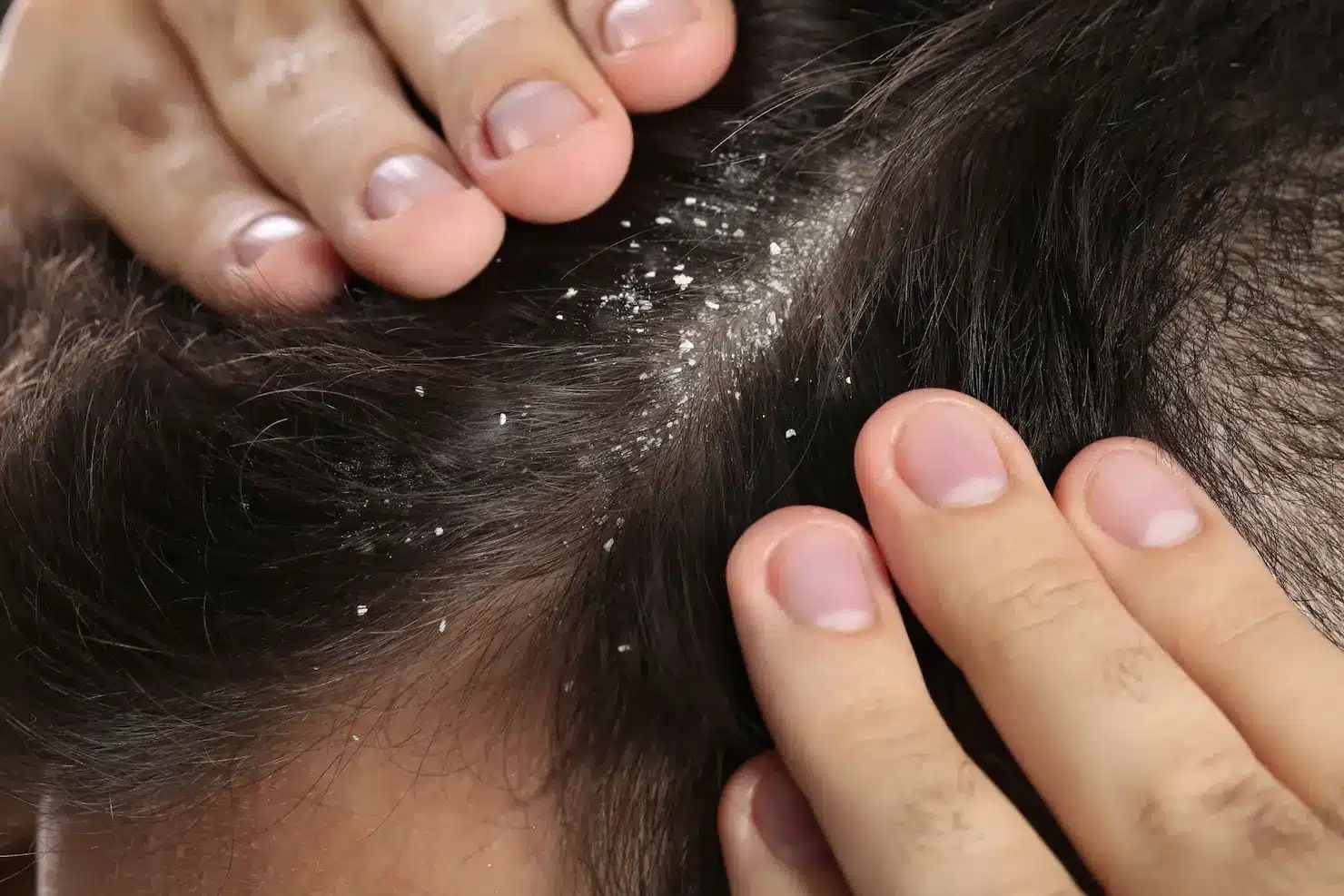 Billede af mand med skæl. bedste skælshampoo til mænd